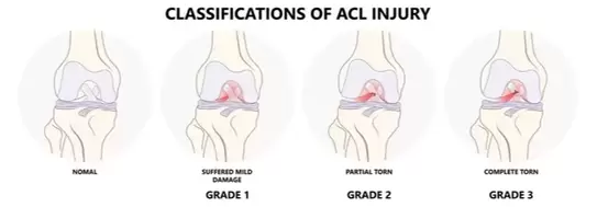 Grades of ACL tear