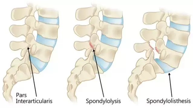 fracture of pars interarticularis leading to spondylolisthesis