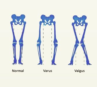 knee valgus, varus and normal positioning